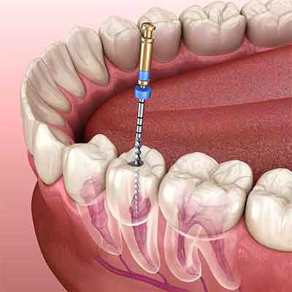 Depiction of a root canal.