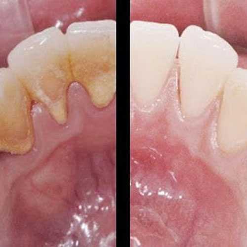 A comparison of dirty teeth vs clean teeth.